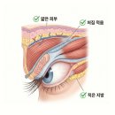 제주쌍꺼풀 "절개/매몰 고민이에요" ...- 의사 답변 -