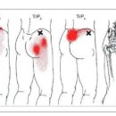Gluteus Medius (중둔근) 이미지