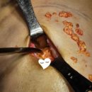 강남엘케이성형외과의원(강남LK성형외과의원) | 가슴필러 제거 및 재수술 후기