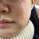 강남피부과 울쎄라 가격 효과 통증 텐써마 리쥬란 후기