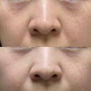 라비에피부과의원 | [내돈내산] 깨순이의 주근깨 레이저 치료 후기 (라비에피부과의원)