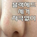 블랙헤드 제거 속에서부터 말끔히 없애준다