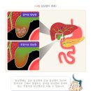 담낭염cholecystitis , 膽囊炎쓸개염 이미지