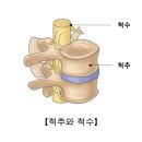 척수 종양[Spinal Cord tumor]뇌신경정신질환, 종양혈액질환 이미지