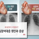 내 심장이 커졌다? 심장비대증 원인과 증상 이미지