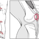 오른쪽 왼쪽 무릎 구부릴때 통증 원인 이미지