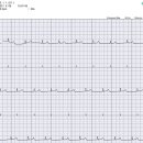 나의 심전도 QRS 높이가 낮은 이유는? 이미지