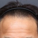 씨유 덕은디에트르점 | 덕은동탈모치료 리제네라 액티바 3개월 후기, 탈모 3단계 진단받고 모발이식 대신 선택한 방법