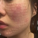 홍익인간 제2 인성관 | 예민성 피부 안면홍조 리쥬란 효과 있을까? 리쥬란 2cc 맞아본 솔직후기 1탄(통증·회복과정)