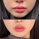 실팔아 | 강남 실리프팅 발품 팔아 찾은 피부과 가격 후기