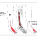 Extensor Hallucis Longus (장무지신근) 이미지