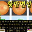 가족삼출유리체망막병증 원인과 치료 방법 - 사암오행침, 사암침법, 오행침, 정통사암침 이미지