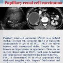 Papillary renal cell carcinoma 유두상 신세포암 이미지