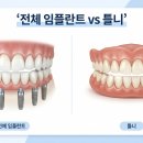 크라운치과기공소 | 용인 전체임플란트, All-on-X부터 원내기공소까지, 보철과 전문의가 직접 설명합니다