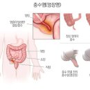 오른쪽 왼쪽 옆구리 통증 원인 이미지