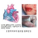 점막피부의 림프절 증후군(가와사키) 이미지