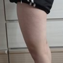 인계동 백성병원앞 | 웨딩관리, 수원 인계동지방분해주사 2회차 솔직후기