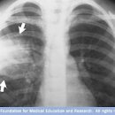 급성 폐렴 증상 초기증상 원인 전염 치료 완치 (기침가래 노란가래) 이미지