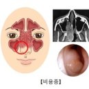 비용종 (Nasal polyp) 이미지