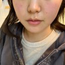 생성공간 | 부산 골드PTT 후기 성인 여드름관리 치료 효과