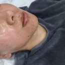 수원-1407 | 수원피부관리 "알테온 기기관리 " 리프팅효과 후기