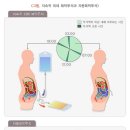 복막 투석이 뭔가요 ..? 이미지