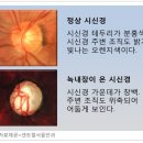 녹내장 안압조절이 가장 중요… 건강보조식품 과신은 금물 이미지