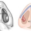 비폐색[nasal obstruction] 이미지