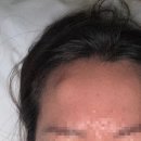 브리즈성형외과의원 | 이마골종 병원 수술 당일 후기