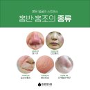 신흥메디칼의원 네이버블로그