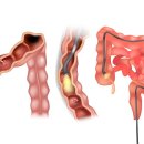 “내시경 중 발견된 대장 용종…모두 암 되는 건 아냐” 이미지