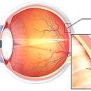 굿모닝 병원 앞 - 우 | 망막전막 수술