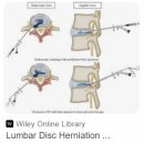 대구제일보조기,의수족 | 대구허리수술재활, 수술 종류별 재활방법, 재활기간 [서부통신경외과] 도수치료, 보행시점, 업무복귀시점
