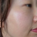 올리브한의원 | 의정부 노원 한의원 기미 제거 치료 레이저 약침 통증 애브넘 잡티 5회차 후기