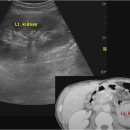 Acute pyelonephritis_swelling 급성 신우신 이미지