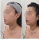 새롬씨티 | 인천 서구 루원시티 피부관리 스며들다 에스테틱 하이푸 윤곽관리 후기