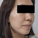 삼성동 피부과 티타늄 리프팅 후기