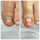 레푸스 부산사직점 | 부산발톱무좀 관리하러 레푸스 동래사직점 재방문후기