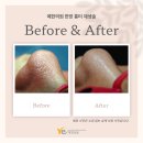 예한의원 | 흉터 치료 EVENT, 굿바이 흉터! 예한의원에서 치료하세요! (+가격, 후기)