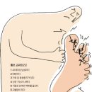 통풍의 치료법(민간요법) 이미지