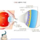 안구 건조증 안약종류 원인 이미지