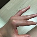 meta plant | [루프스 병 완치 일기 1탄] 초기 증상 및 원인, 나비모양 피부 홍반