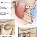 턱관절 통증 원인 및 턱에서 나는 소리 자가진단 방법 이미지