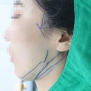 (주)탑스코 | 얼굴 실리프팅 후기, 각 부위별 전후 총 정리 버전