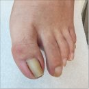 포쉬네일 풀리메디 안산점 | 안산내성발톱 불편함에서 벗어나다 포쉬네일 동성제약 풀리메디 안산점