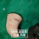 분당서울정형외과 네이버블로그