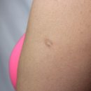 두창(痘瘡, Smallpox) — 인류가 박멸한 유일한 치명적 감염병 — 이미지