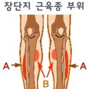 척추 질환과 보행 장애의 모든 원인에 따른 치료법. 이미지