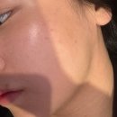 대치더블유피부과의원 | 대치역 피부과 튠페이스 + 쥬베룩볼륨 후기｜금손 원장님 튠베룩 시술로 자연스러운 얼굴볼륨 완성✨