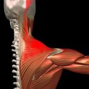 ▒ 근막통증증후군 : 어깨통증 이미지